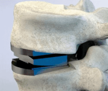 Imagen: Un reemplazo discal compatible en la columna lumbar (Foto cortesía de Crocker Spinal Technologies).